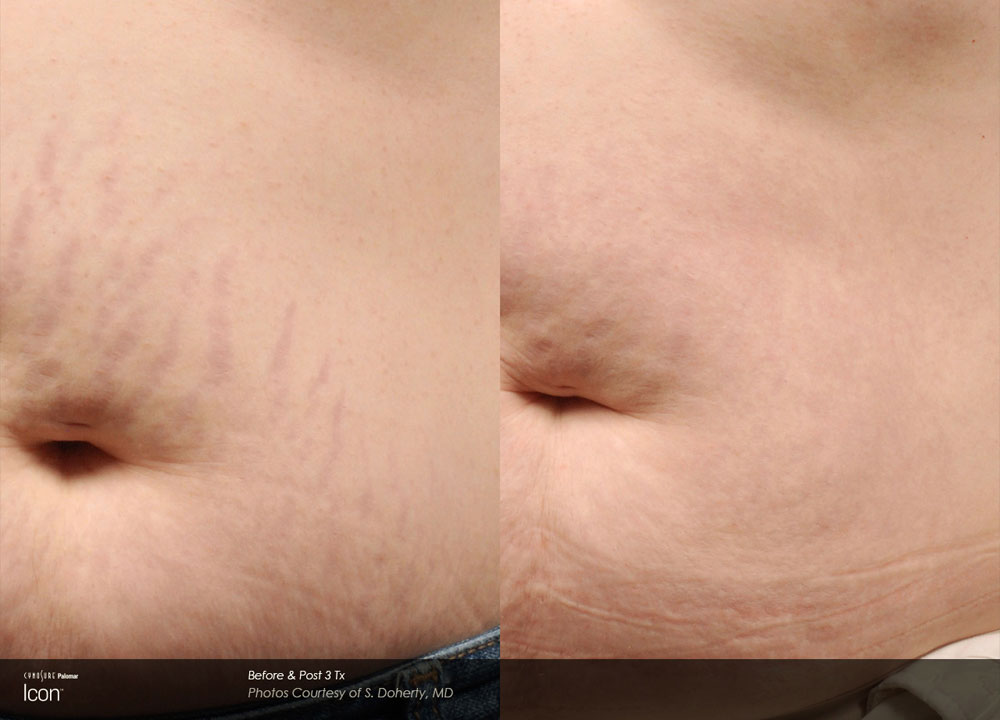 Schwangerschafts und Dehnungsstreifen in Winterthur Sanabelle